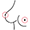 Gynäkomastie