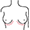 Bruststraffungsoperation