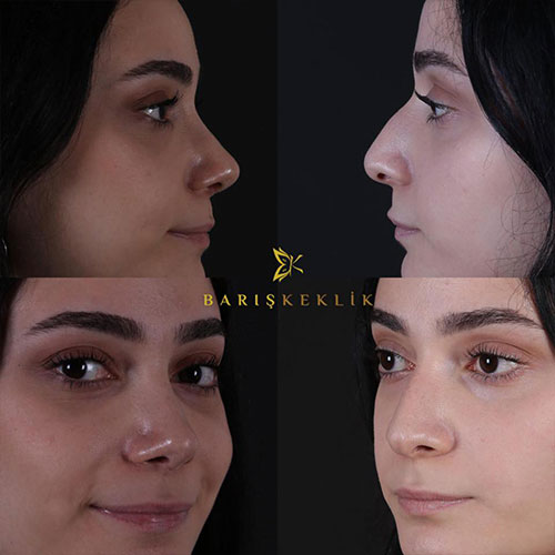 before-after