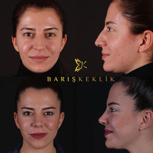 before-after