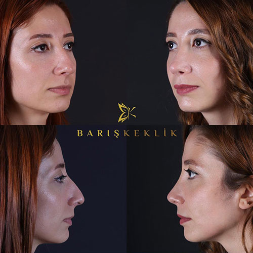 before-after