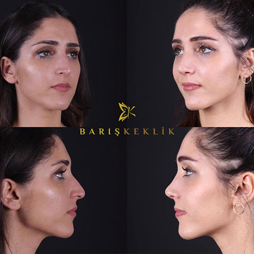 before-after