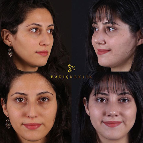 before-after