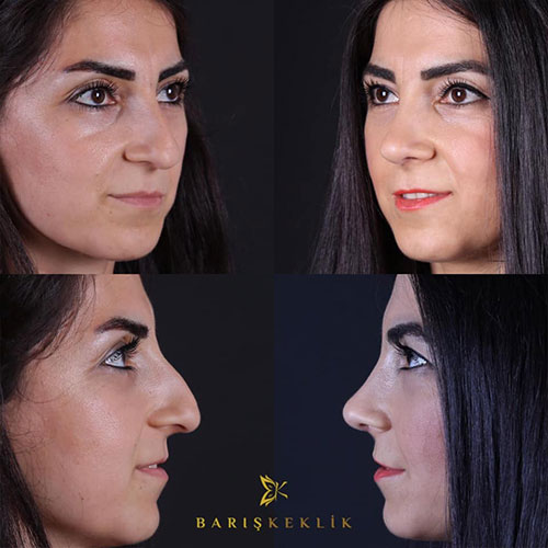 before-after