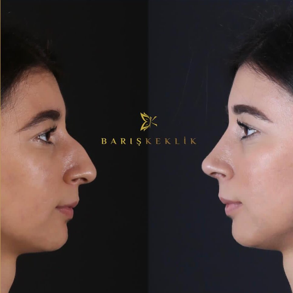 before-after
