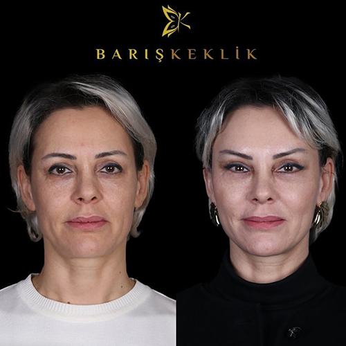 before-after