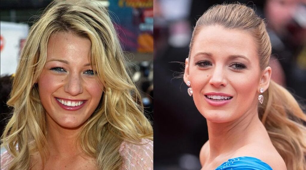 Blake Lively before after