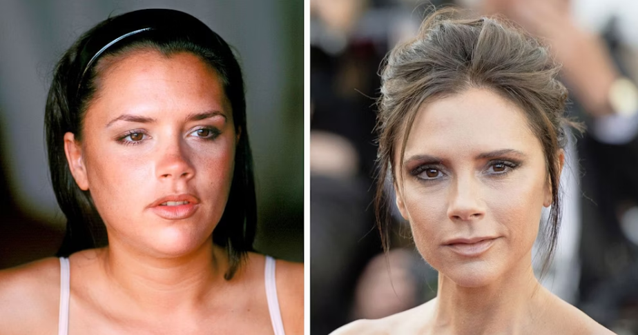 victoria beckham burun estetigi.jpg